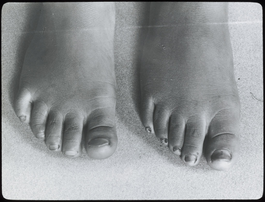 Donald Baxter MacMillan; Feet (2) of Northwest Greenland Woman; 1913-1917; image; silver gelatin on glass; 10.16 cm x 8.26 cm x 0.64 cm (4 in. x 3 1/4 in. x 1/4 in.); TGM; North America