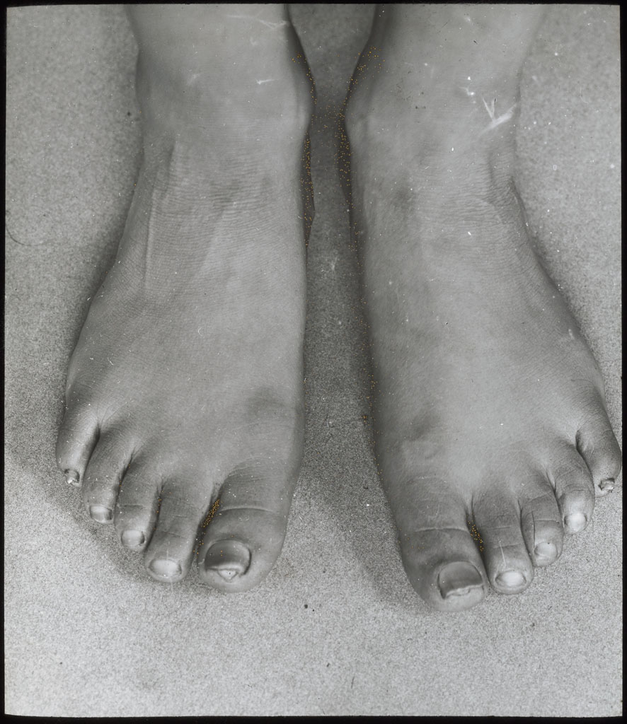 Donald Baxter MacMillan; Ah-ning-ya's feet. Age 35 [on lantern slide: Feet of Ahl-ning-wah]; 1913-1917; image; glass; 8.26 cm x 10.16 cm (3 1/4 in. x 4 in.); TGM; North America